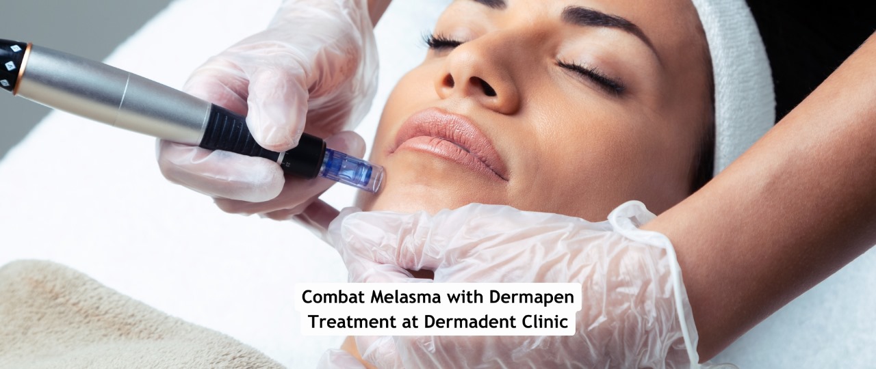 Combat Melasma with Dermapen Treatment at Dermadent Clinic