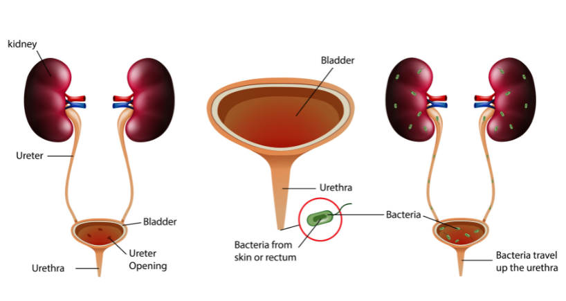 Understanding Melena Symptoms | Fortis Healthcare