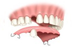 Single Tooth Replacment | Ace Dental