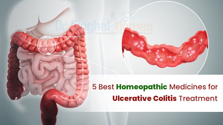 5 Best Homeopathy Medicines for Ulcerative Colitis