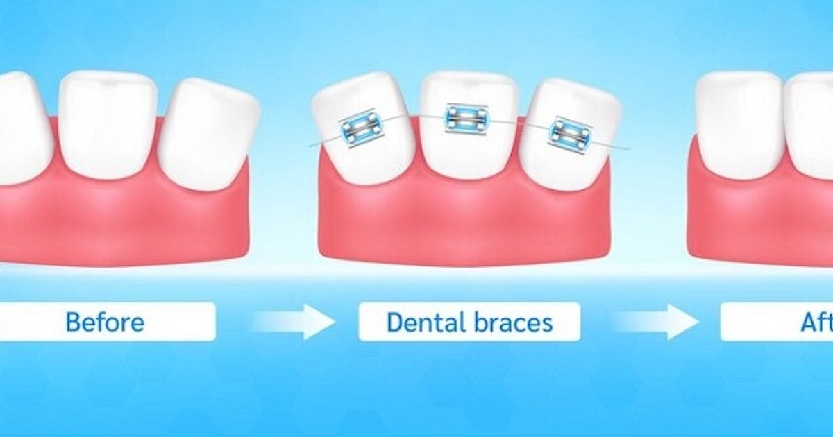 Effective Orthodontics Treatment in Preston for All Ages