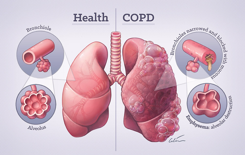 Comprehensive Pulmonary Diagnoses in Bakersfield, CA | Asthma, Emphysema & More