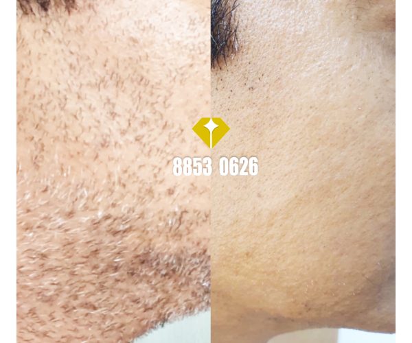 Beard Laser Hair Removal in Singapore | Best Hair Removal