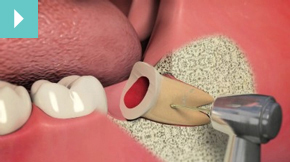 Oral Surgery Whitton - Eye Smile