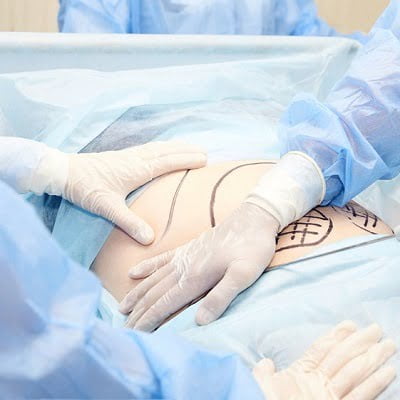 Liposuction in Islamabad - Best Surgeon For liposuction in Islamabad