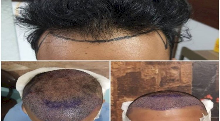 Is Hair Transplant in Pakistan Worth It? - Free instant approval guest posting Website