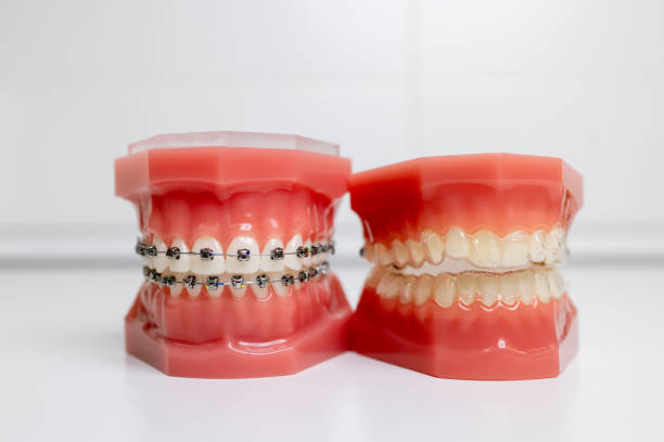 Invisalign vs. Traditional Braces: Which Orthodontics Option is Right for You? - Buddies Reach