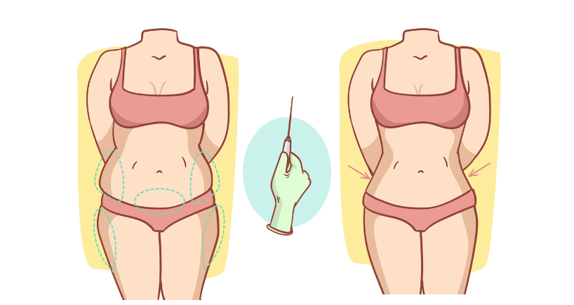 Benefits of a Tummy Tuck | Fortis Healthcare