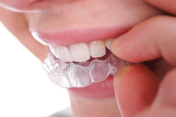 Achieving a Perfect Smile with Invisalign Treatment