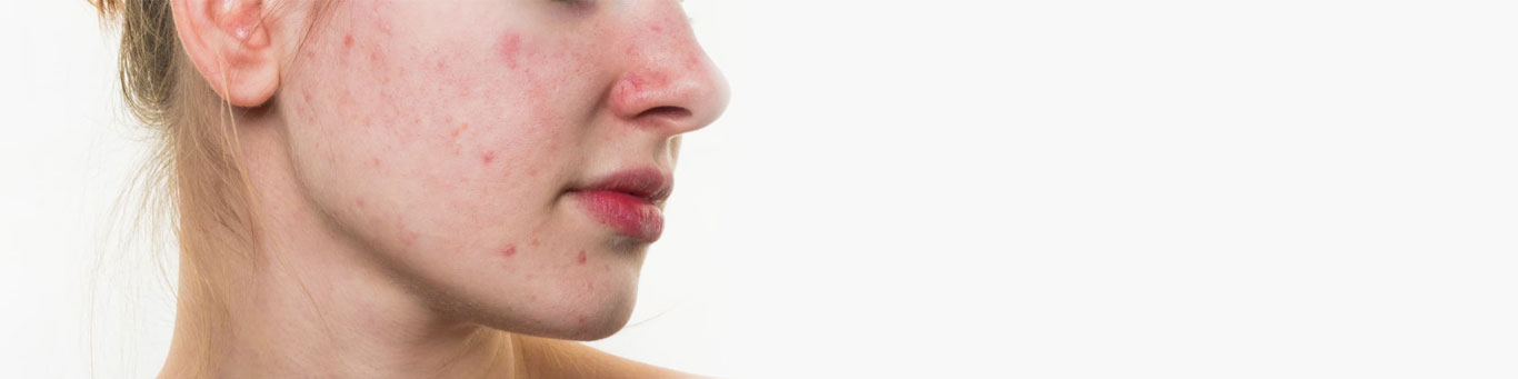 Acne Scar Removal Treatment In Delhi | Acne Scar Treatment Cost In Delhi