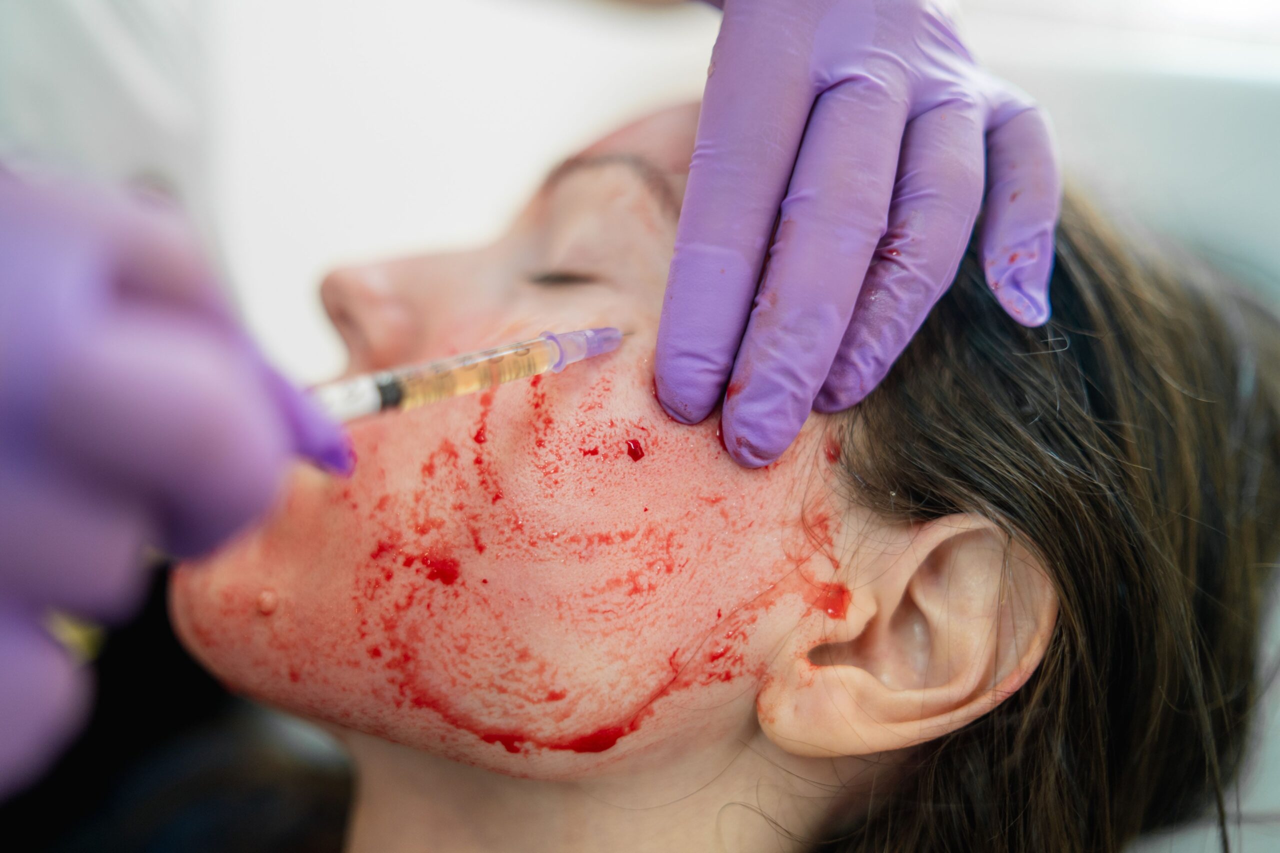 What’s a Vampire Treatment Course and How Can It Help You? -