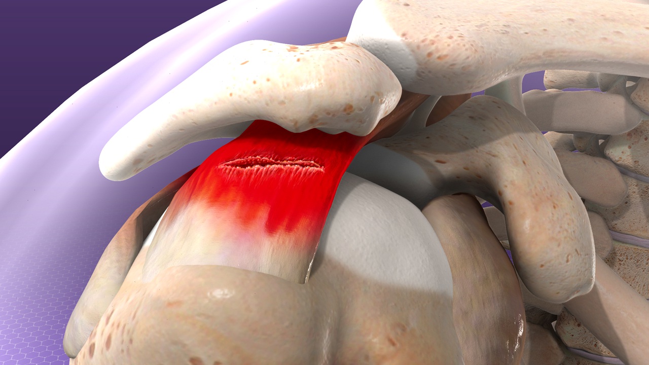 Effective Treatments for Rotator Cuff Pain in Houston