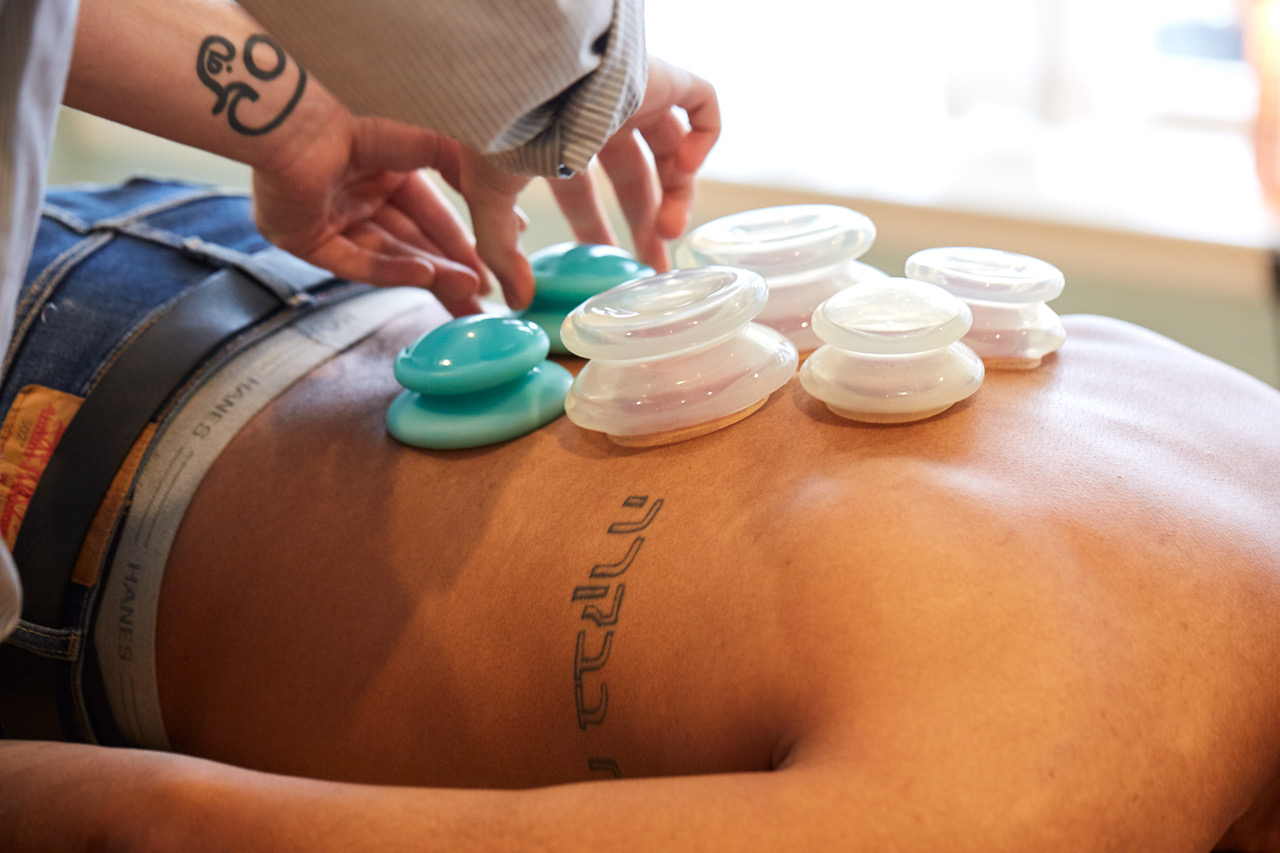 Cupping - a modern twist on an ancient therapy - Six Fishes