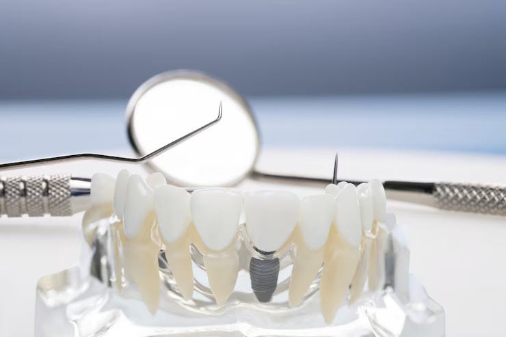 The Absolute Beginner’s Guide: Implant Dentistry | by All on Implants Dental Centre | Dec, 2024 | Medium