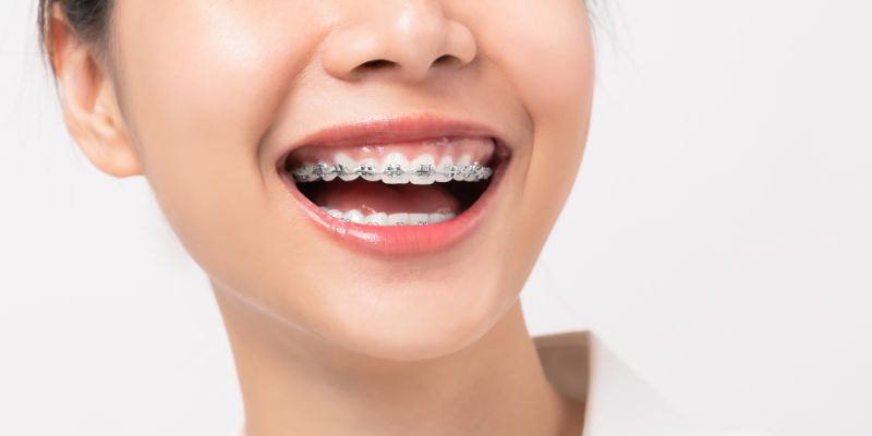 Braces Treatment in Chinchwad | Braces Treatment Cost in Chinchwad