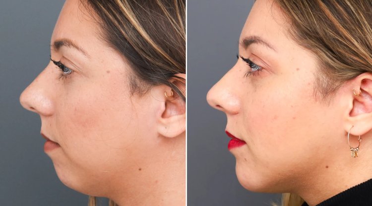 Kin Filler: Achieve a Revitalized Look Comfortably Without Surgery - Omaha News Wire