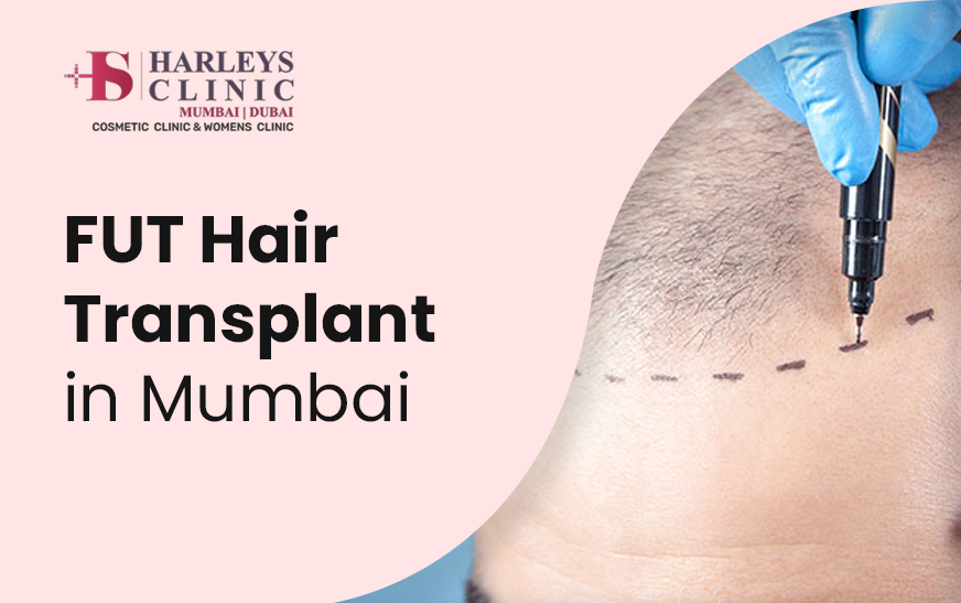 Aftercare Tips for a Successful FUT Hair Transplant | by Dr. Sumit Agrawal | Jan, 2025 | Medium