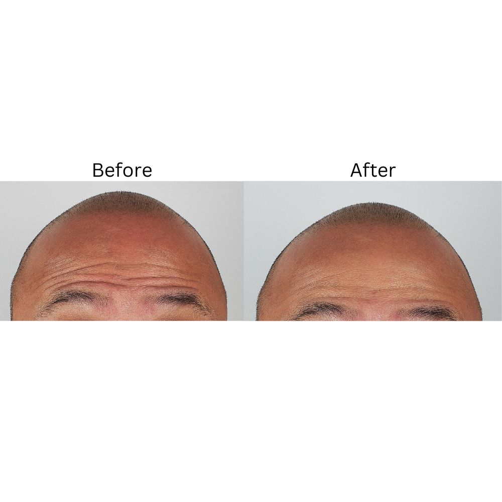 Botox Treatment Kuwait | Dr. Vivek Singhal