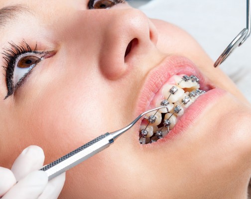 Dental Braces in Abu Dhabi | Orthodontists in Abu Dhabi