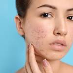 Acne scar treatment in Islamabad Profile Picture