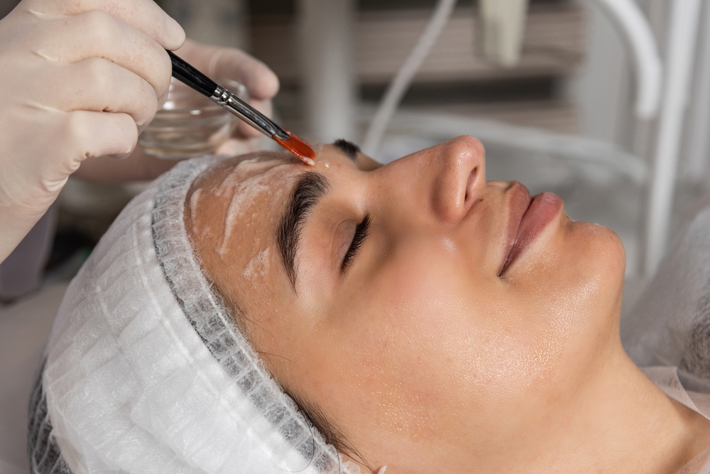 Revitalize Your Skin with Chemical Peel Treatment