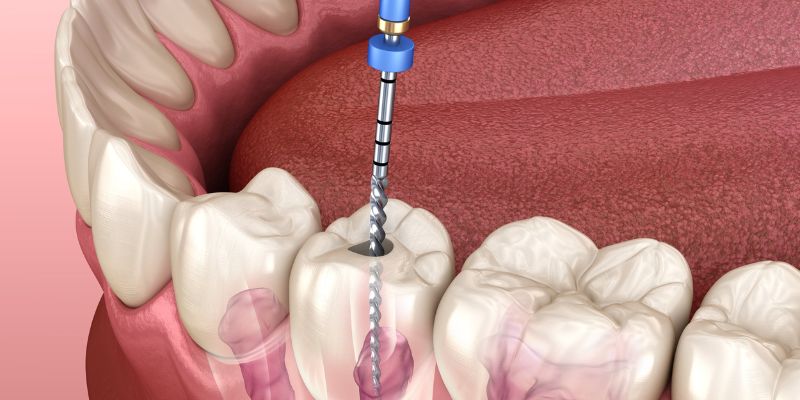 Root Canal Treatment in Chinchwad | RCT Cost in Chinchwad