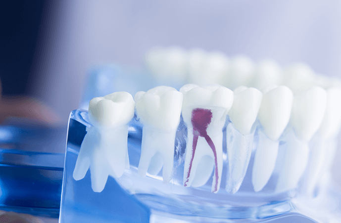 Pain-Free Root Canal Treatment Melbourne CBD – Save Your Smile