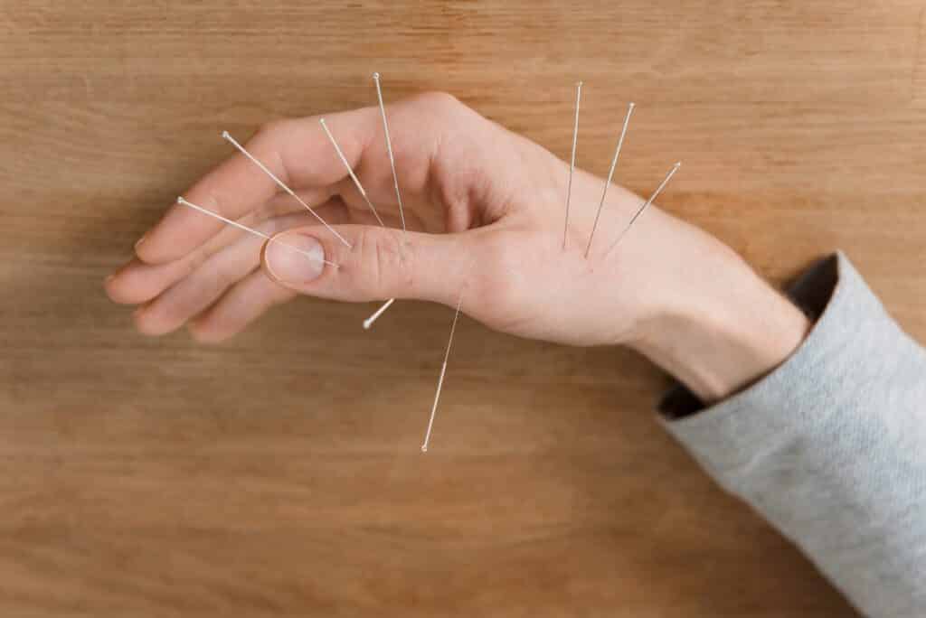 Anatomical Acupuncture Grande Prairie | GP Pain Physio