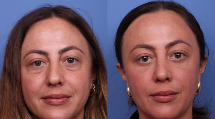 Understanding Blepharoplasty & Its 3 Stages - PR Business Wires