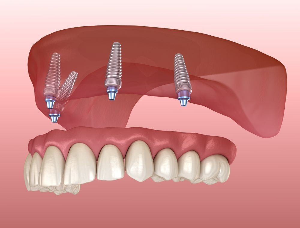 Dentures Vs All-on-4 Dental Implants: A Complete Guide | Buzzy