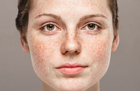 Dark Spots: Causes and How to Get Rid of Them? - Dr Sabrina™