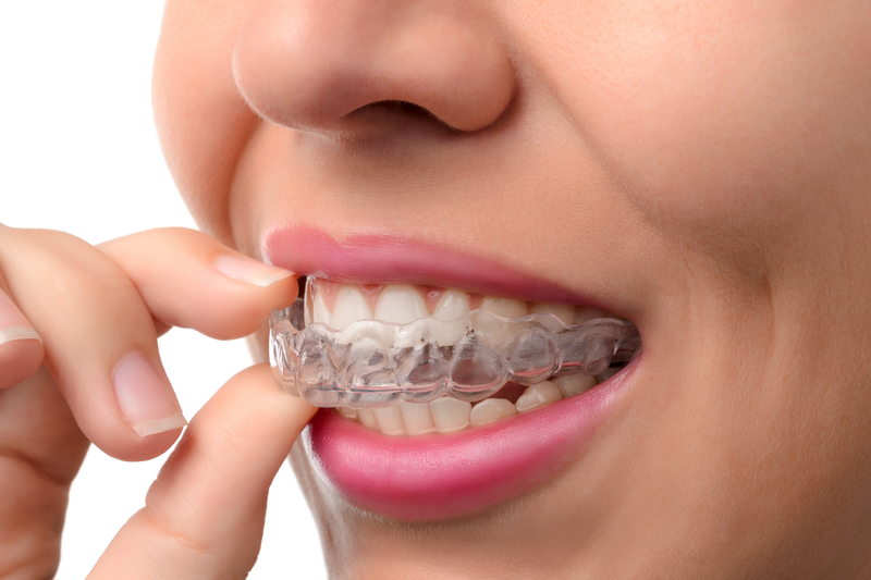 5 Key Benefits of Choosing Clear Aligners for Teeth Straightening – Telegraph