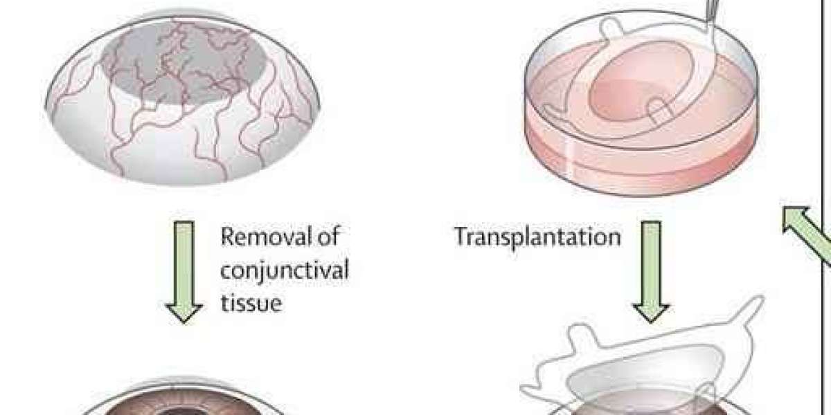 Breakthrough in Vision Loss Treatment: Japanese Scientists Use Stem Cells to Regenerate Corneal Tissue