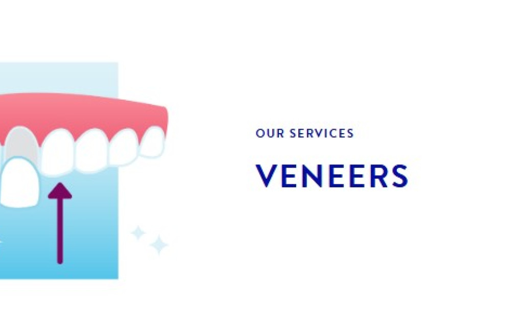 How to Transform Your Smile with Veneers in Bartlett