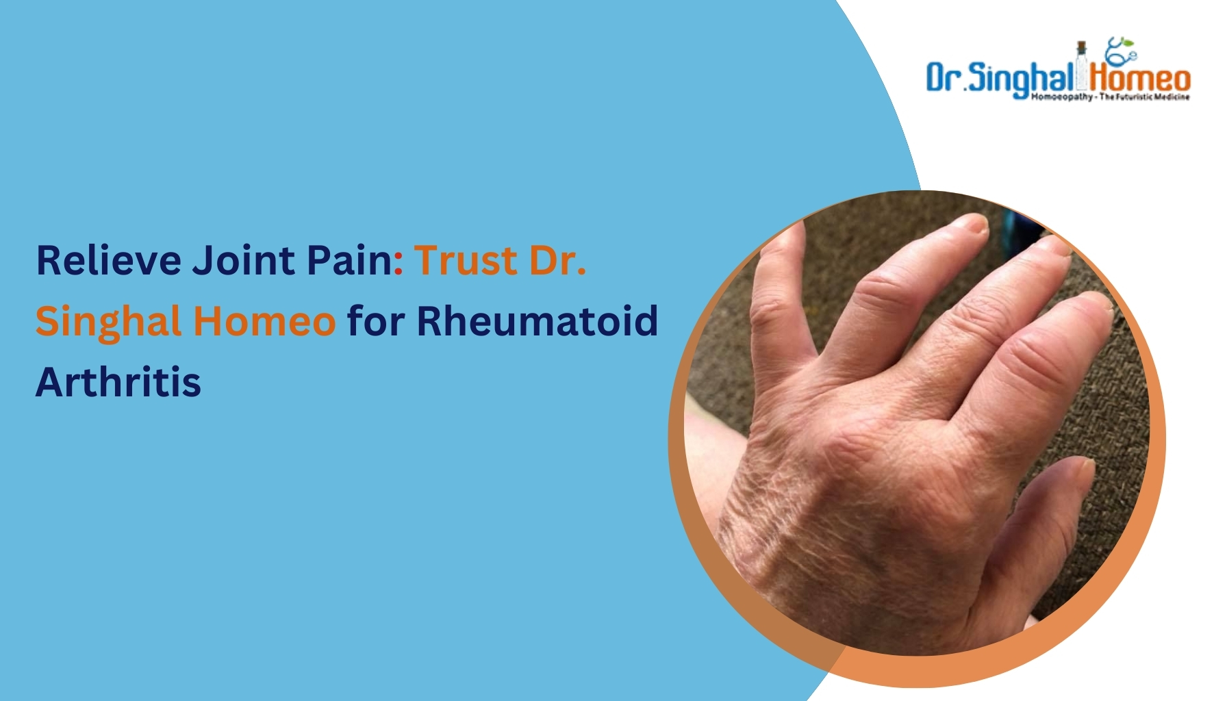 Why Choose Homeopathic Medicines for Rheumatoid Arthritis? – health