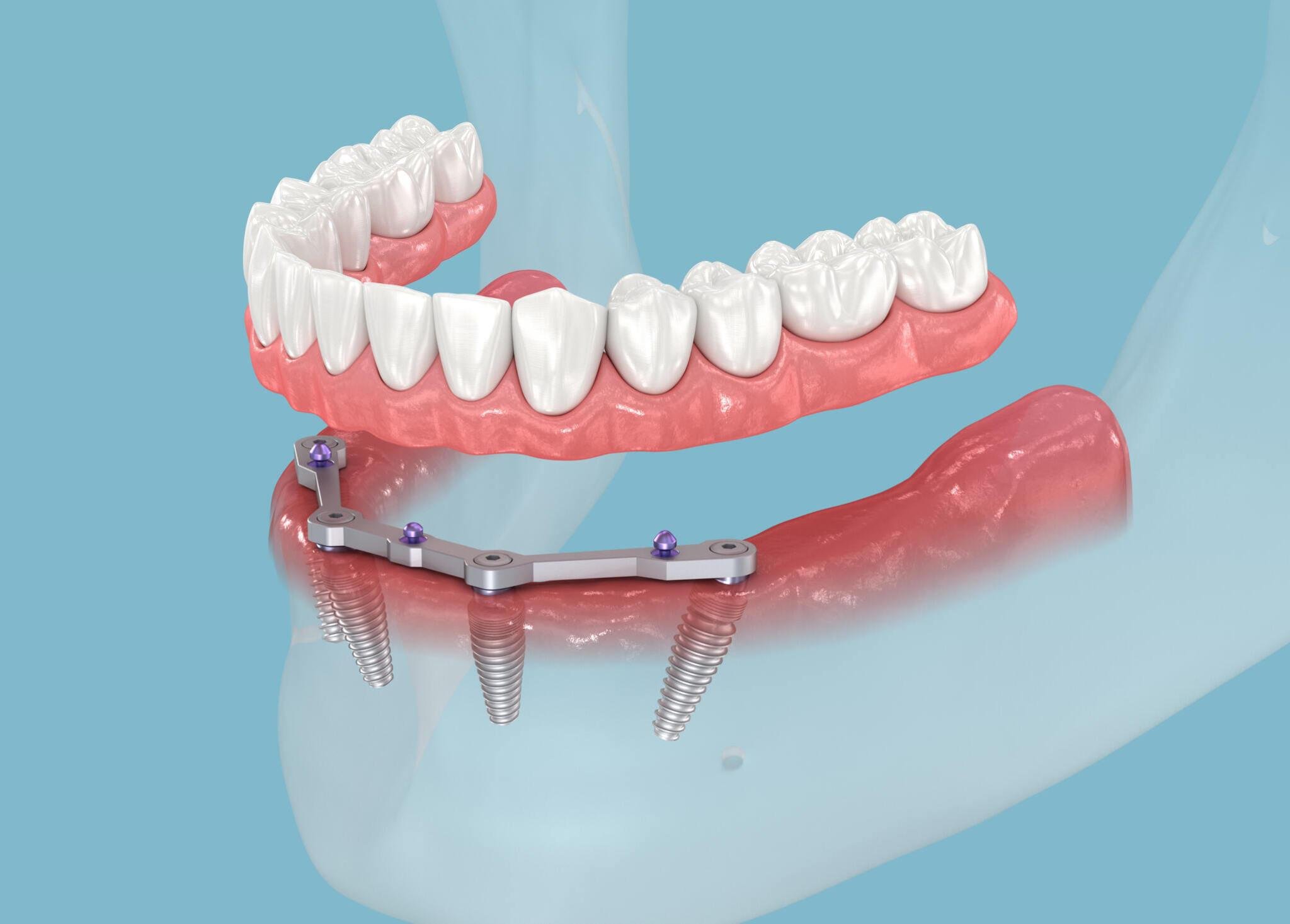 Why More Patients Are Choosing All-on-4 Over Dentures – Telegraph