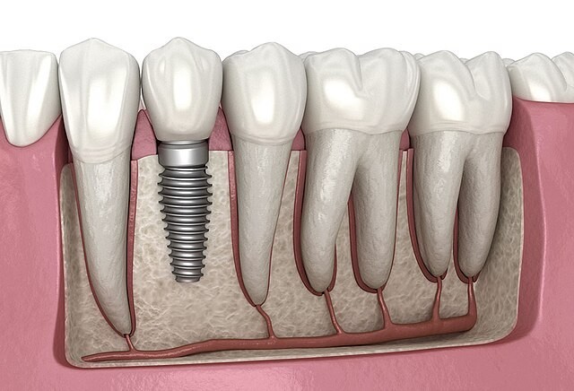 How Dental Implants Work and Why They Are a Game Changer | Buzzy