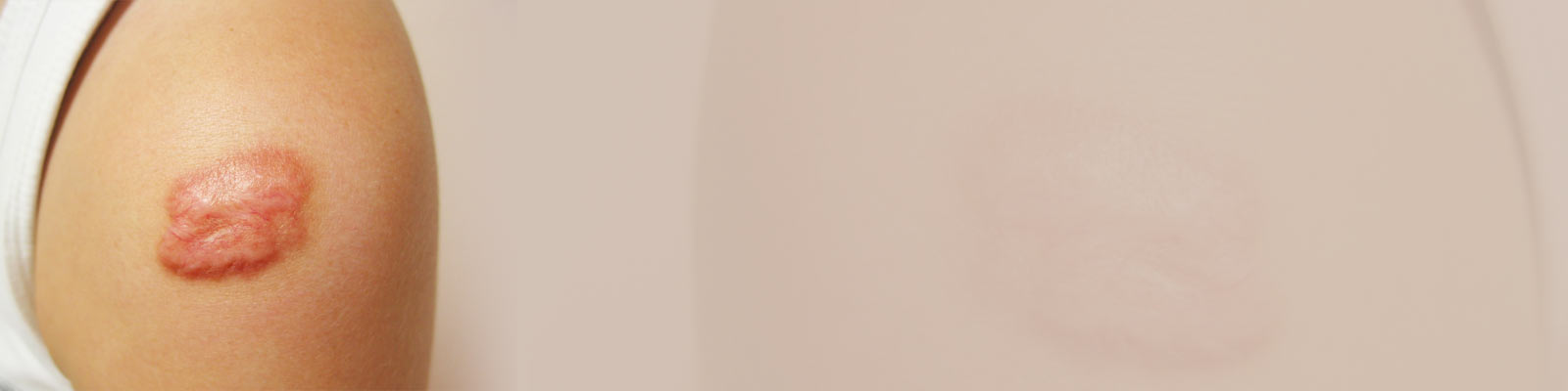 Best Keloid Treatment in Delhi | Best Keloid Doctor in Delhi, West Delhi