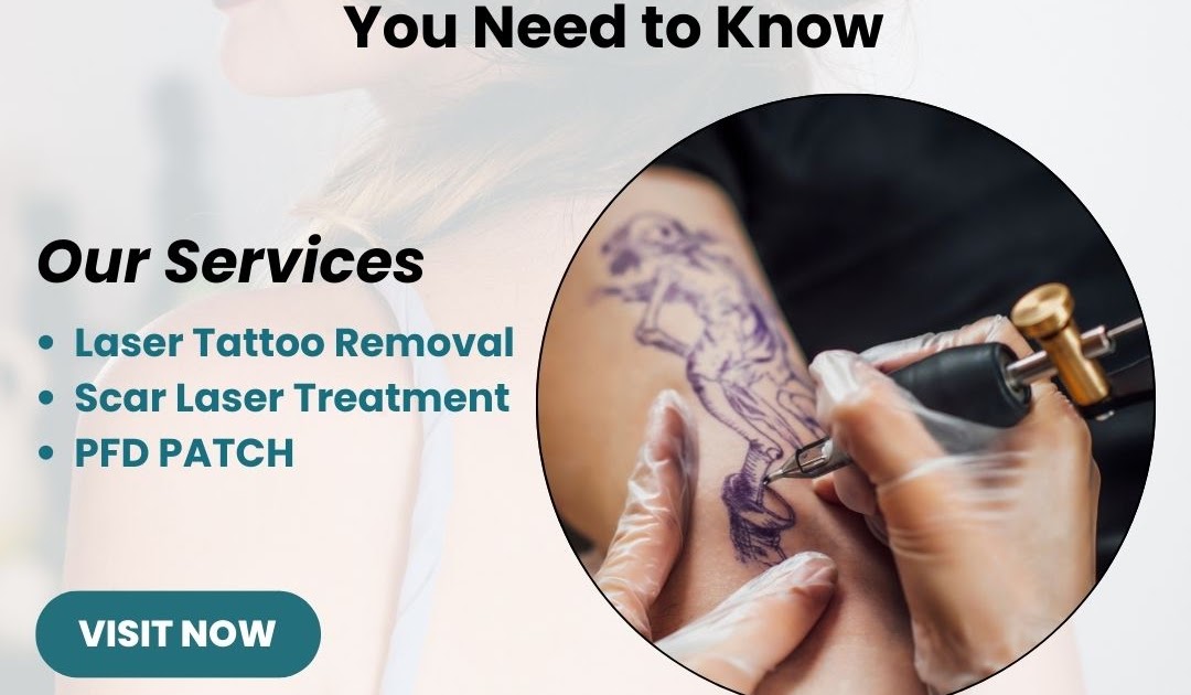 Cost to Laser Remove Tattoo: What You Need to Know