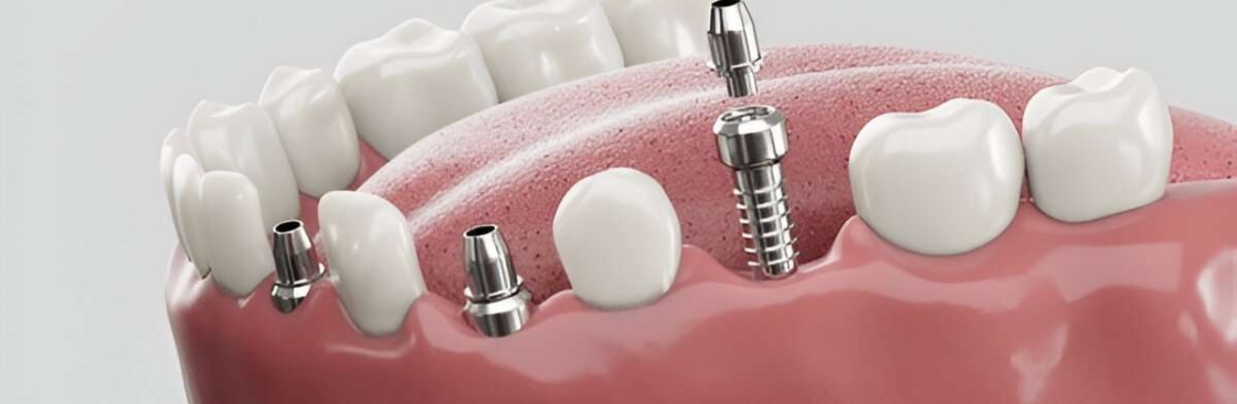 Siiodent implants Cover Image