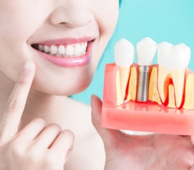 How to Find the Best Dental Implant Specialist in Hawthorn – @hawthorneastdentalme on Tumblr