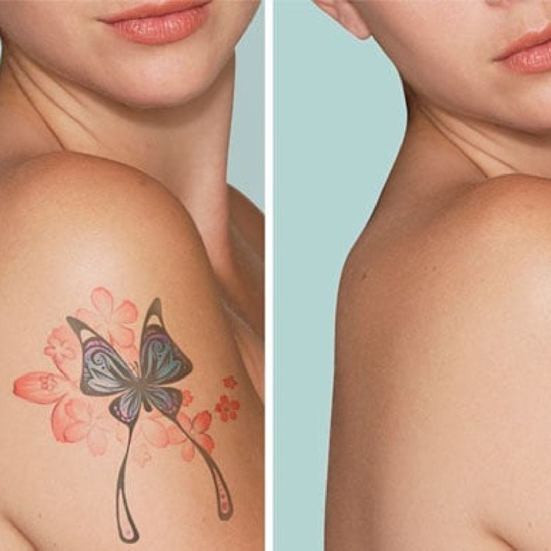 Effective and Affordable Tattoo Removal with Care Credit Options