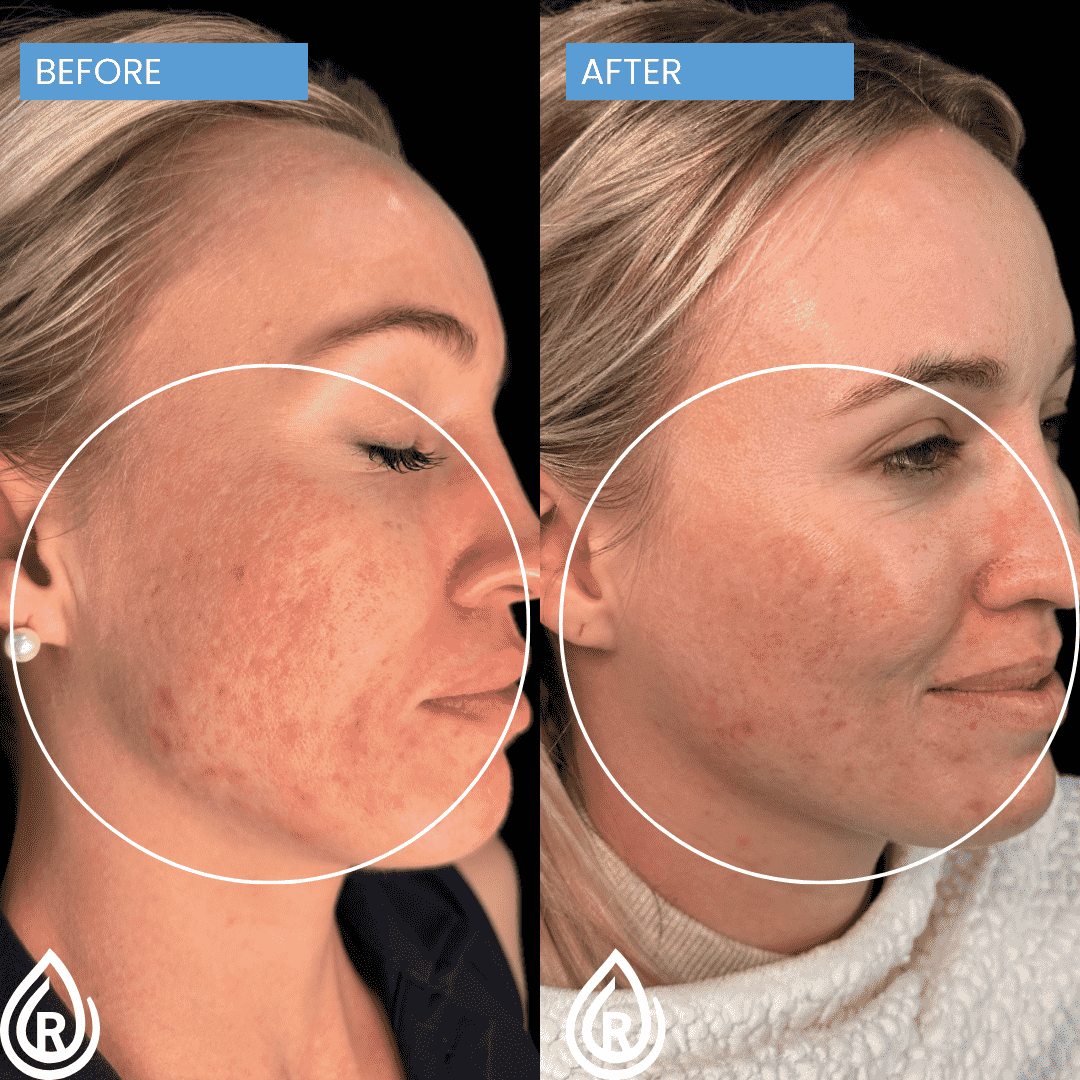 How Microneedling Can Improve Your Skin’s Texture?