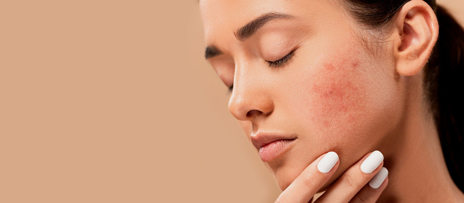 Say Goodbye to Breakouts with Professional Acne Treatment Vienna - Tech Chron