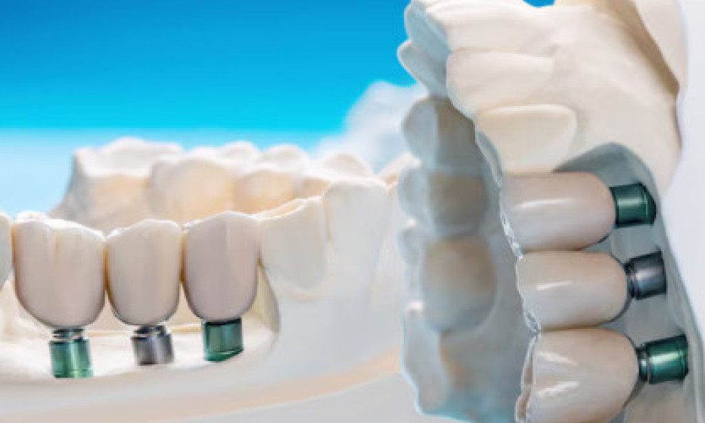 Dental Implants: How Benefits for Smile, Bone Health & Function