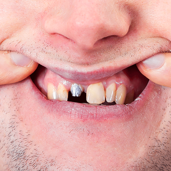 What Causes Dental Implants To Get Unscrewed - VIP Dental Implants