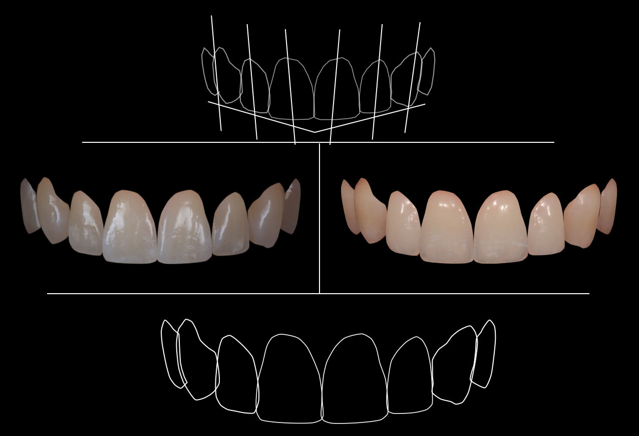 Custom Veneers Smile Makeover in Largo FL | Blue Dental