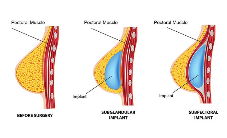 Breast Augmentation Surgery in Delhi | Breast Augmentation Surgery Cost