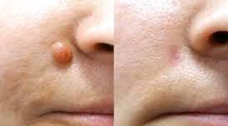 The Truth About Skin Growths: What’s Harmless and What’s Not - Dubai Entertainment