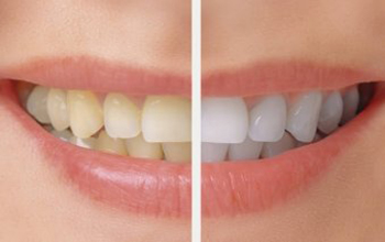 Teeth Whitening Treatment in Nagpur | Welldent